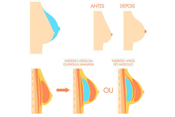 Resultado de imagem para Silicone atrapalha a amamentação?